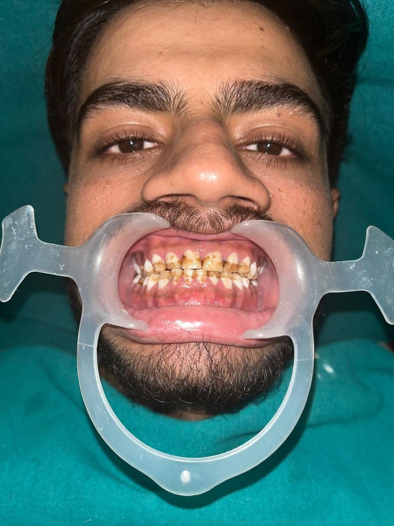 Before professional dental scaling and cleaning in Rohtak